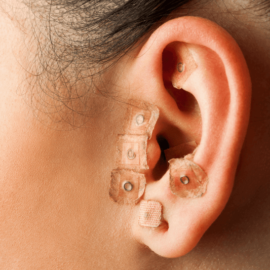Auriculoterapia